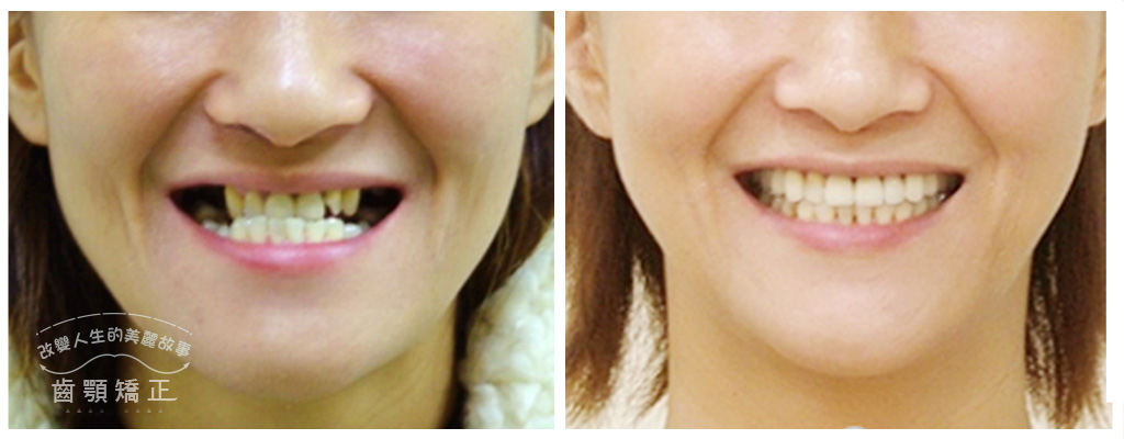從「戽斗女生」到自信大笑─齒顎矯正權威鄭信忠院長牙科手術的改變